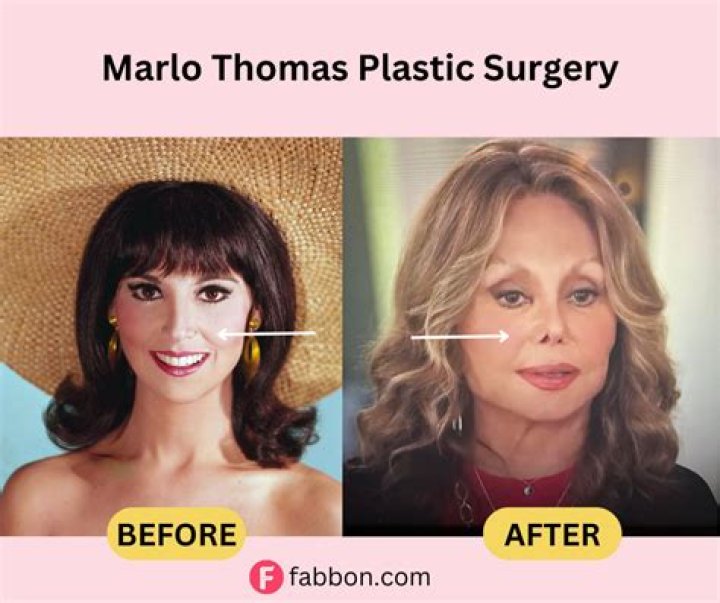 Has Marlo Thomas had Plastic Surgery Facelift Nose Job Plastic