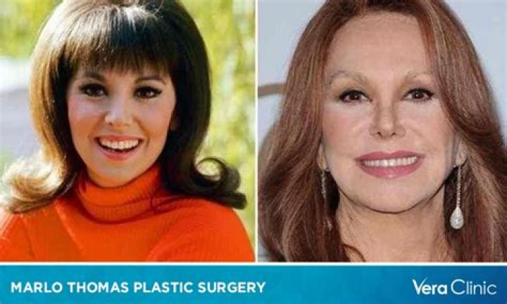 Marlo Thomas Plastic Surgery With Before And After Photos